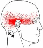 tension headache referral/pain pattern