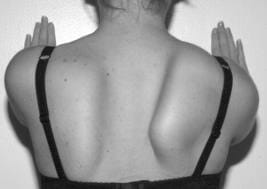 winging scapula shoulder blade