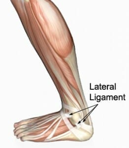 sprained ankle - lateral ligaments