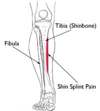 shin splint pain