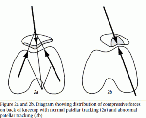 Patellofemoral pain syndrome. self treatment and rehab at home to decrease pain and get you back to it!