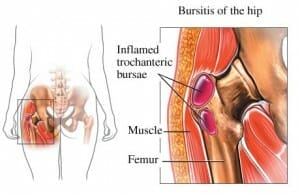 Trochanteric-Bursitis