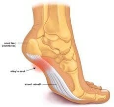 Plantar fasciitis treatment and exercises