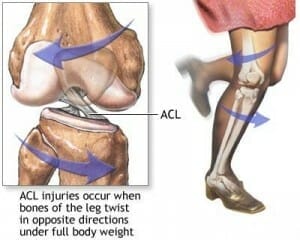 acl mechanism