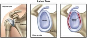 shoulder labral tear