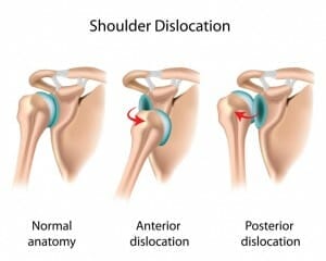 shoulder dislocation physio