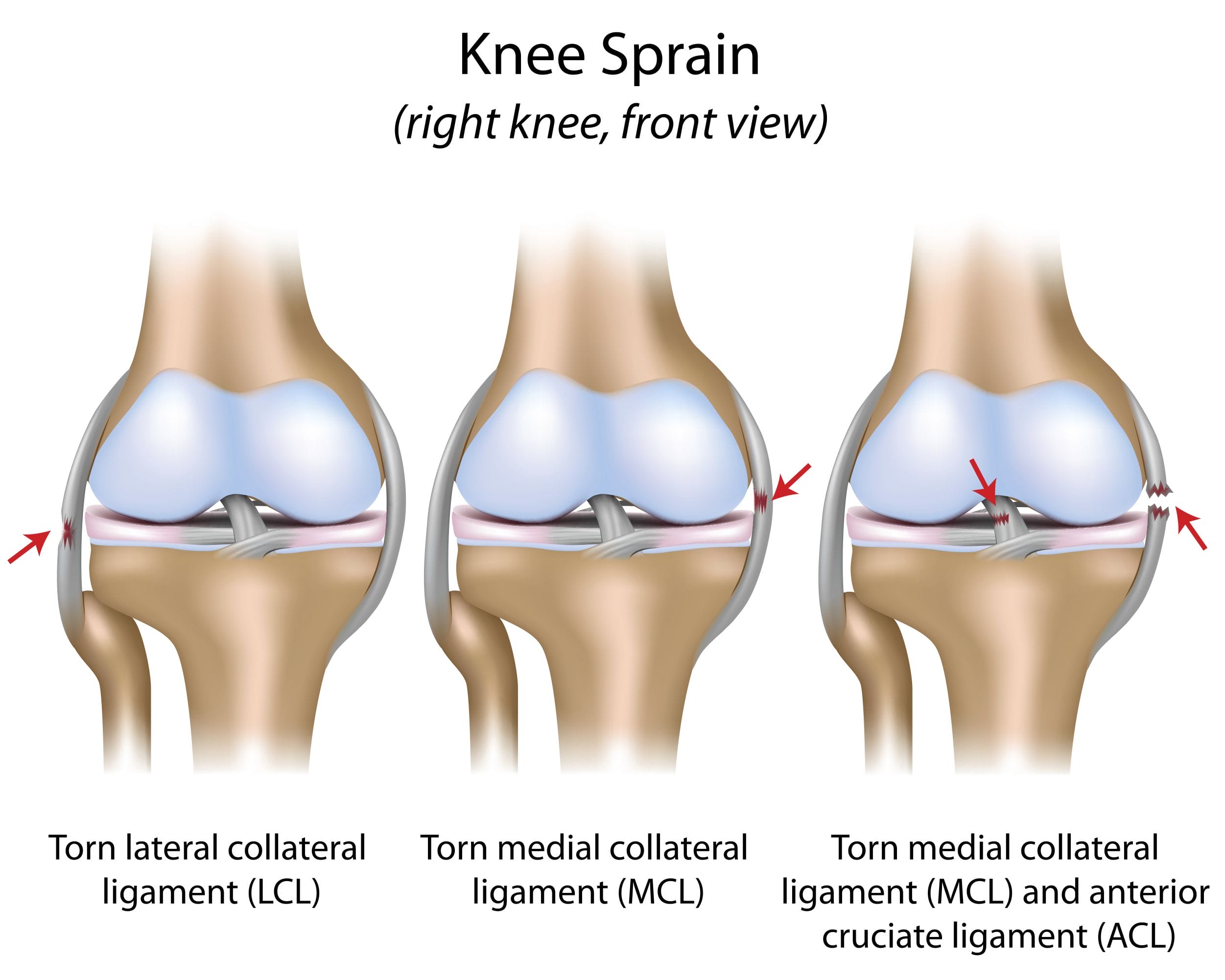 Torn Ligament sprained knee Physio Prescription