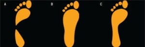 pronated foot - 5 running myths busted