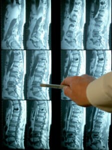 MRI spondylosis