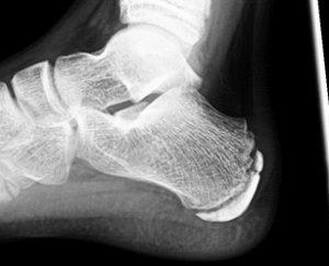 severs xray