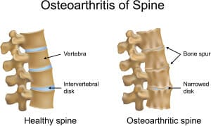 spondylosis MRI findings need to be using smartly