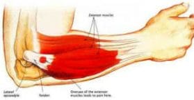 Epicondylitis tennis elbow exercises