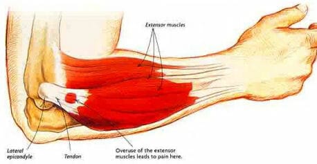 Epicondylitis tenis elbow exercises