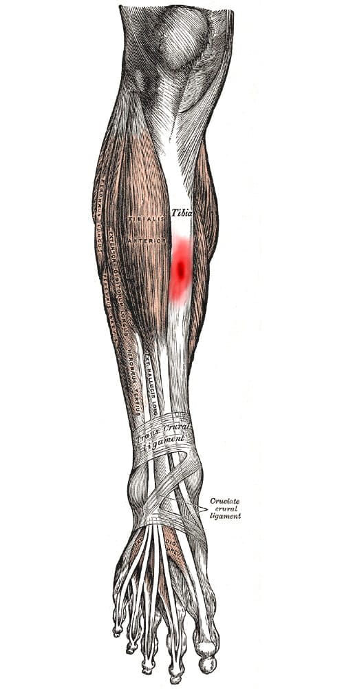 Stress fracture shin