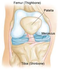 meniscus tear