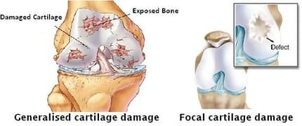 strengthen cartilage