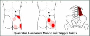 Ql Quadratus lumborum trigger point muscle knots