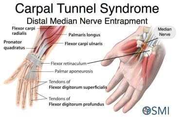 Carpal tunnel syndrome avoid surgery