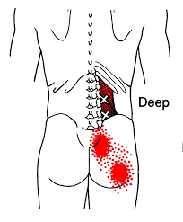 Quadratus lumborum pain