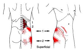 Quadratus lumborum pain