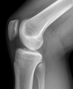 knee cracking - what causes it