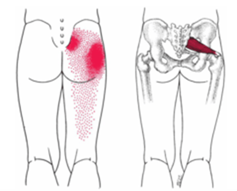 Piriformis syndrome Symptoms and pain patterns